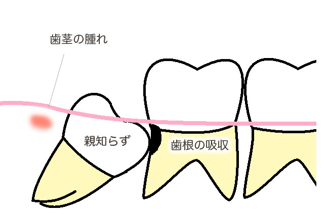 歯茎の腫れ