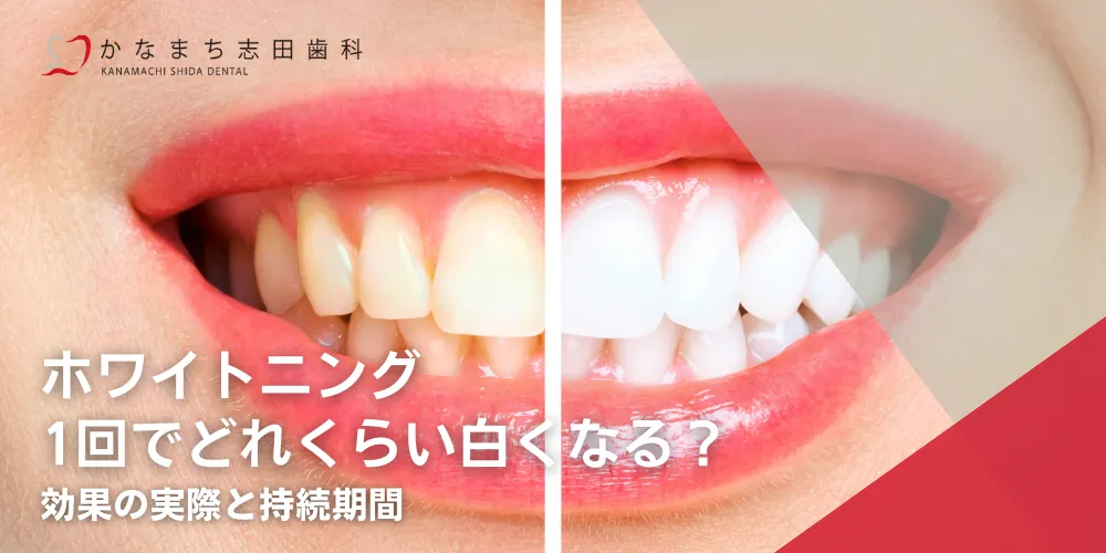 ホワイトニング1回でどれくらい白くなる？効果の実際と持続期間