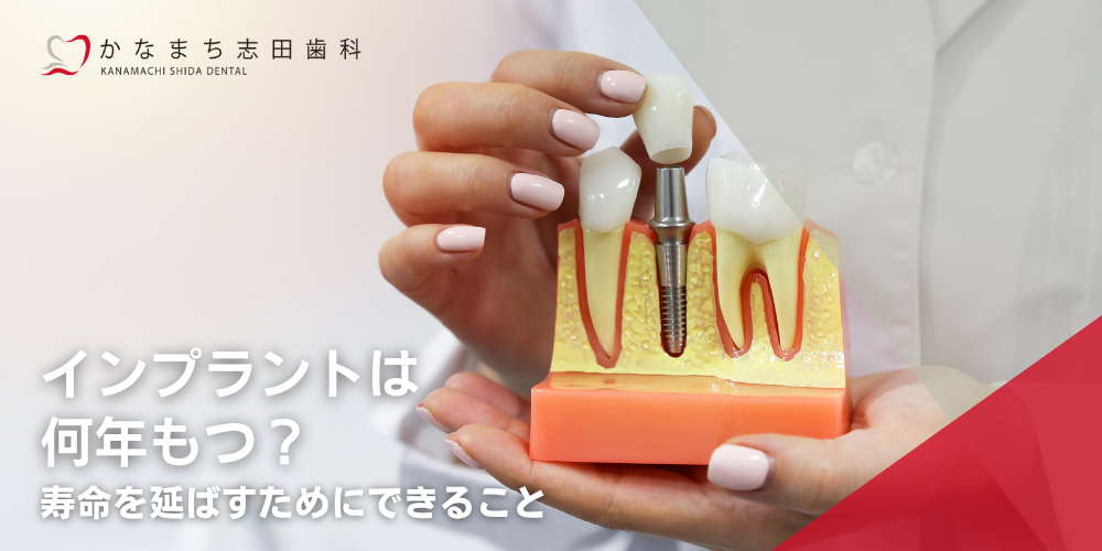 インプラントは何年もつ？寿命を延ばすためにできること