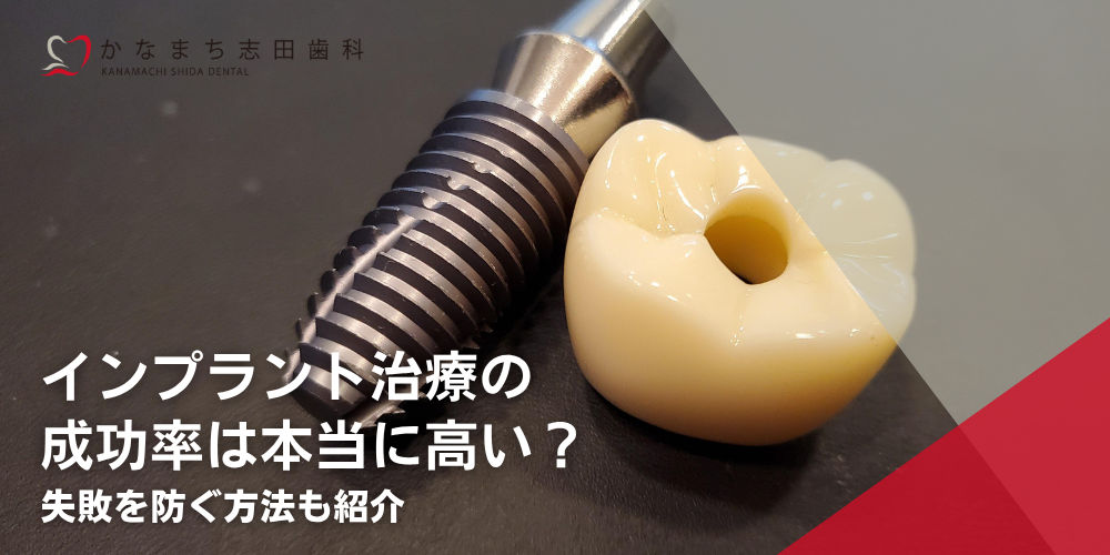 インプラント治療の成功率は本当に高い？失敗を防ぐ方法も紹介