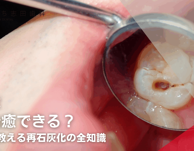 虫歯は自然治癒できる？専門医が教える再石灰化の全知識