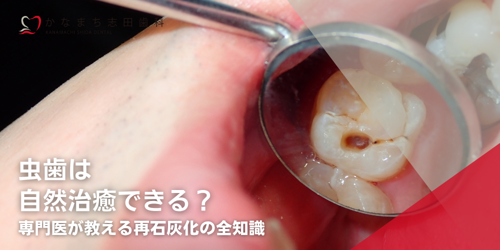 虫歯は自然治癒できる？専門医が教える再石灰化の全知識