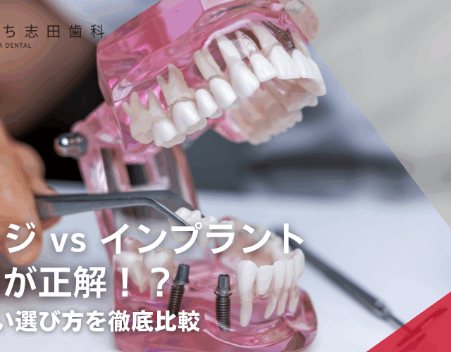 金町の歯医者･歯科「かなまち志田歯科」｜ブリッジ vs インプラントどっちが正解！？後悔しない選び方を徹底比較