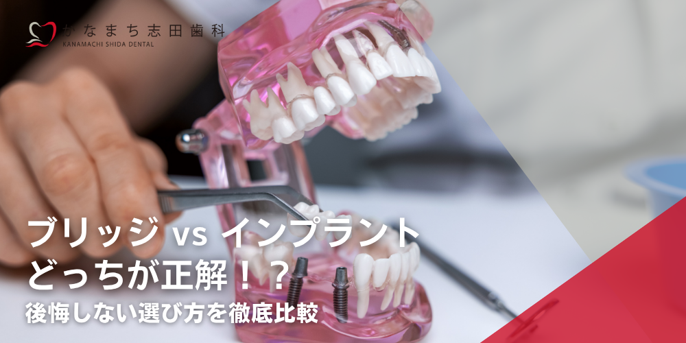 ブリッジ vs インプラントどっちが正解！？後悔しない選び方を徹底比較