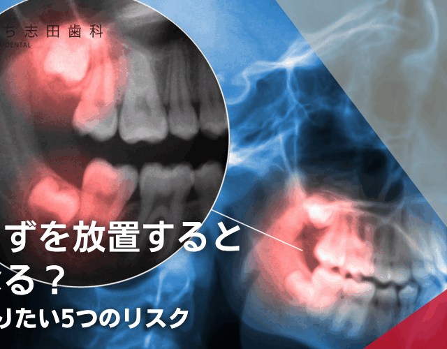 親知らずを放置するとどうなる？今すぐ知りたい5つのリスク