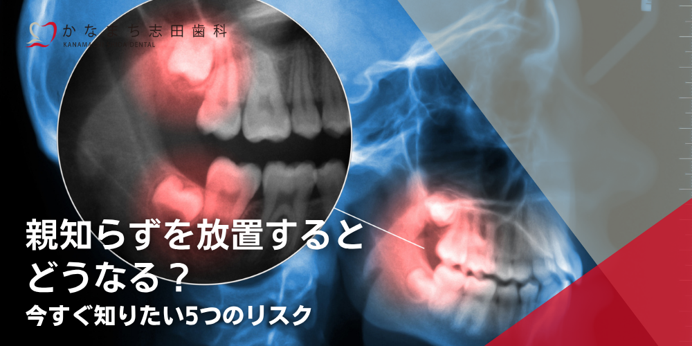 親知らずを放置するとどうなる？今すぐ知りたい5つのリスク