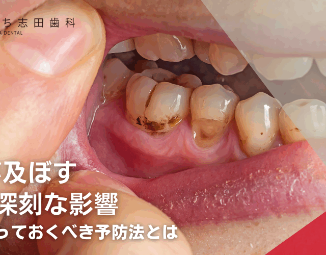 虫歯が及ぼす5つの深刻な影響：今すぐ知っておくべき予防法とは