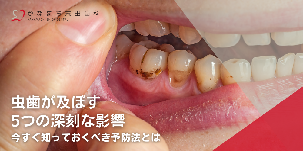 虫歯が及ぼす5つの深刻な影響：今すぐ知っておくべき予防法とは