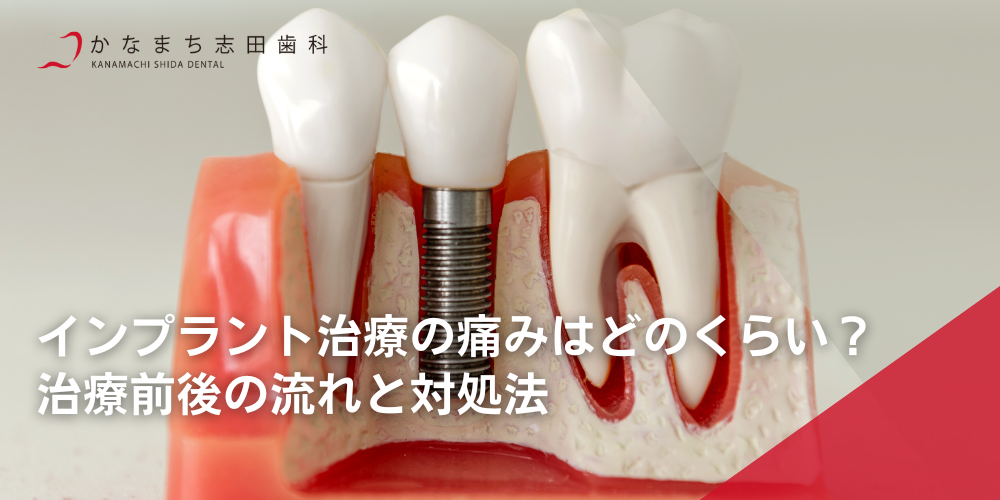 インプラント治療の痛みはどのくらい？治療前後の流れと対処法