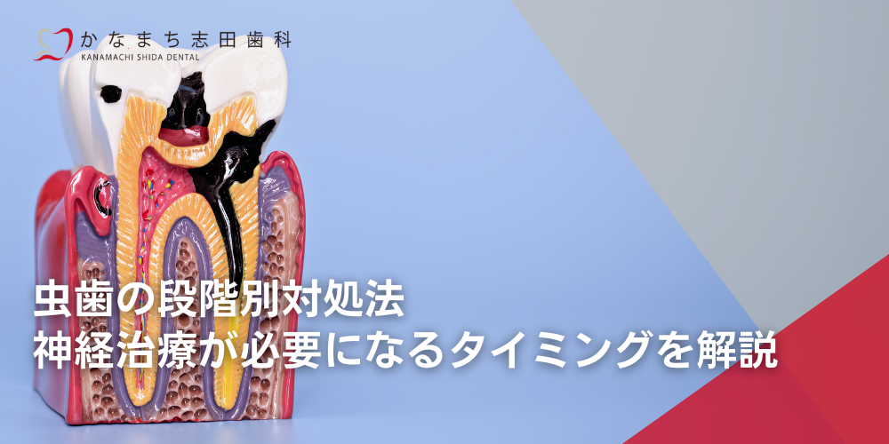 虫歯の段階別対処法：神経治療が必要になるタイミングを解説