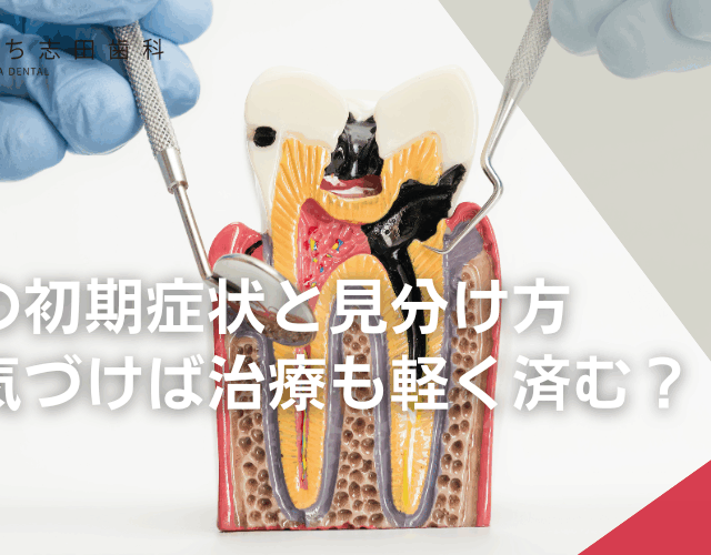 虫歯の初期症状と見分け方｜早く気づけば治療も軽く済む？