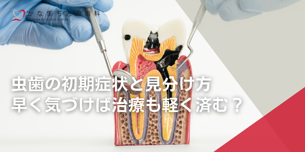 虫歯の初期症状と見分け方|早く気づけば治療も軽く済む?