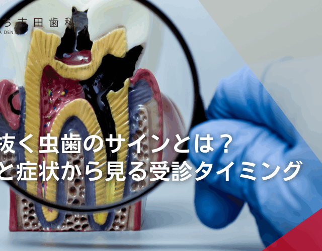 神経を抜く虫歯のサインとは？進行度と症状から見る受診タイミング