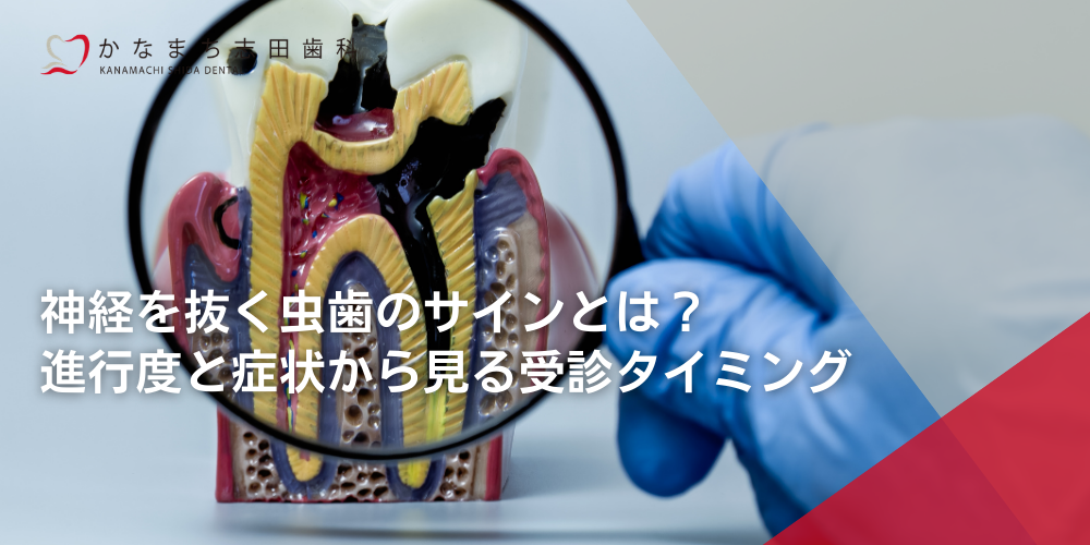 神経を抜く虫歯のサインとは?進行度と症状から見る受診タイミング