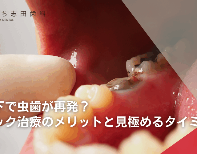 銀歯の下で虫歯が再発？セラミック治療のメリットと見極めるタイミング