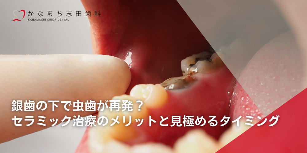 銀歯の下で虫歯が再発？セラミック治療のメリットと見極めるタイミング