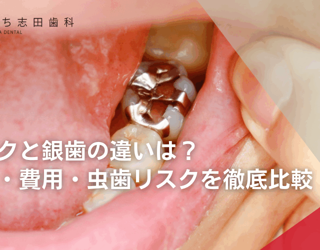 セレックと銀歯の違いは？見た目・費用・虫歯リスクを徹底比較