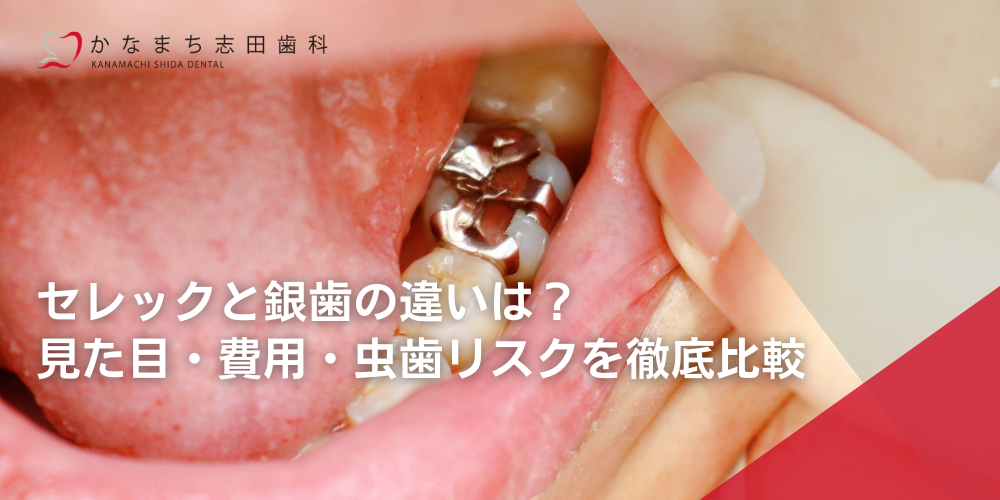 セレックと銀歯の違いは?見た目・費用・虫歯リスクを徹底比較