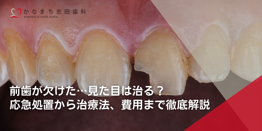 前歯が欠けた…見た目は治る?応急処置から治療法、費用まで徹底解説