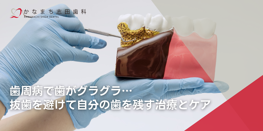 歯周病で歯がグラグラ…抜歯を避けて自分の歯を残す治療とケア