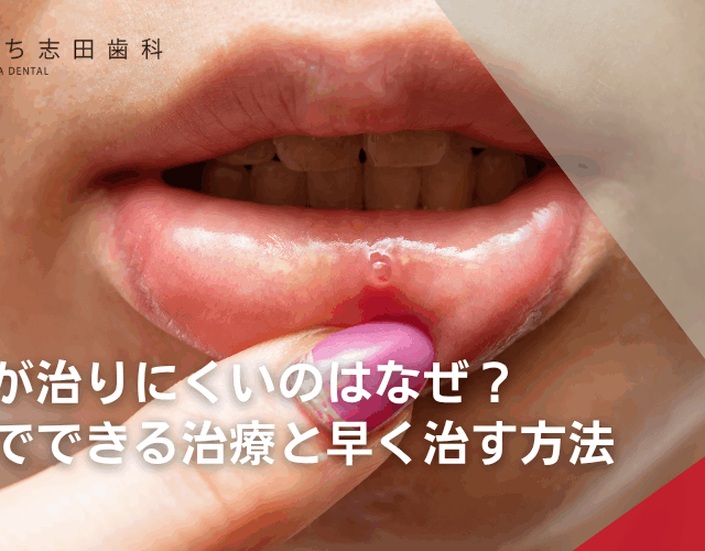 口内炎が治りにくいのはなぜ？歯医者でできる治療と早く治す方法