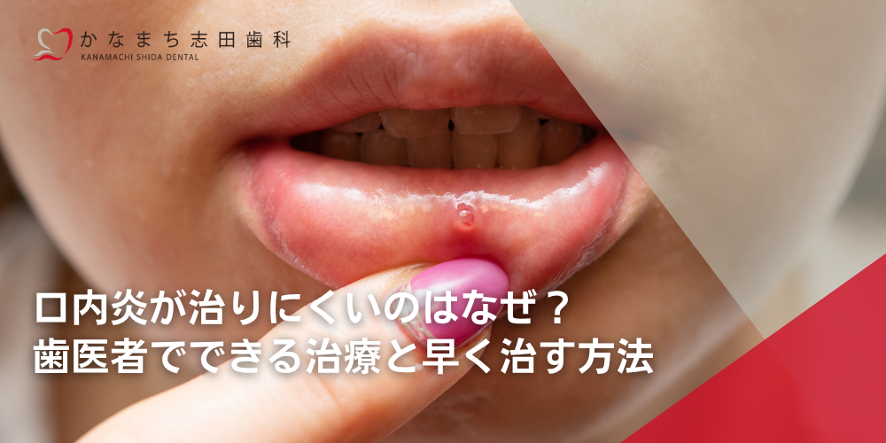 口内炎が治りにくいのはなぜ?歯医者でできる治療と早く治す方法